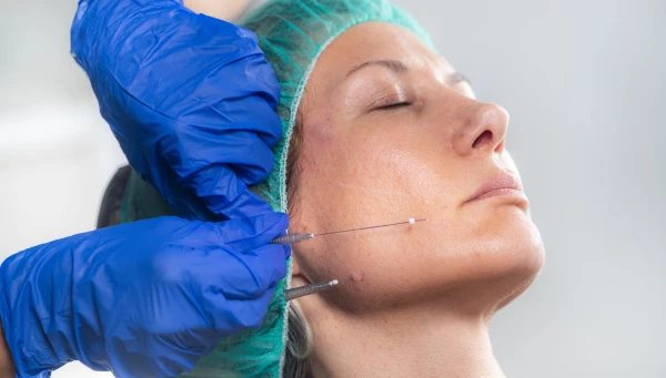 hilos-tensores-espiculados Aplicación de hilos tensores espiculados en el rostro de una mujer.