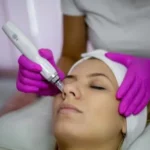lapiz dermapen tratamiento