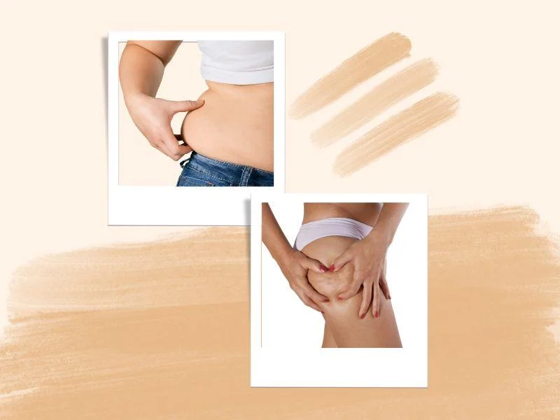 diferencia-entre-radioterapia-corporal-y-presoterapia Grasa localizada en abdomen y celulitis en piernas en mujeres.
